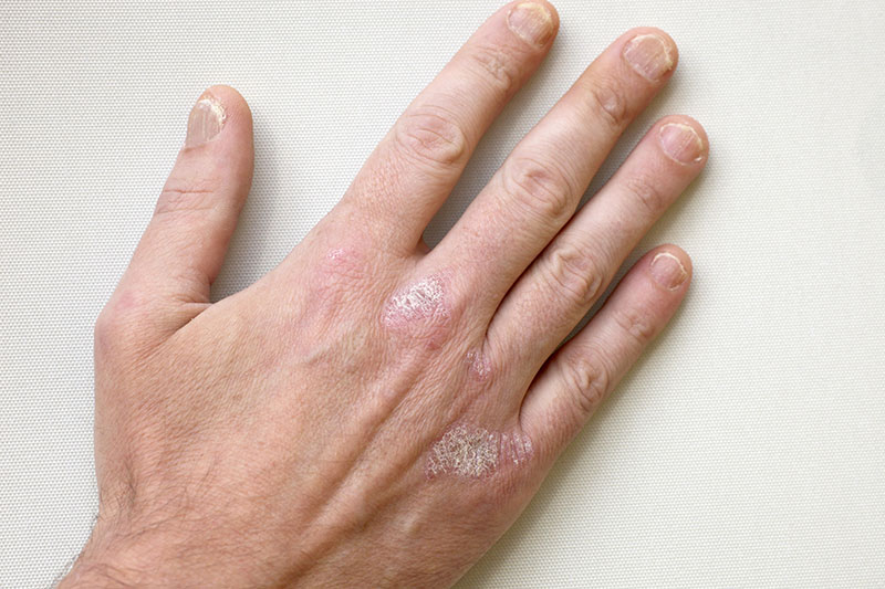 Psoriasis - Symptome an der Handoberfläche