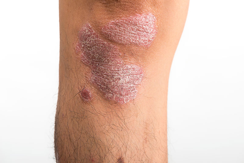 Psoriasis - Symptome am Knie