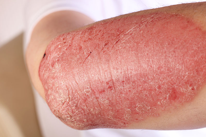 Psoriasis - Symptome am Unterarm